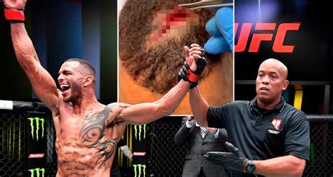 Ufc Star Suffers Gruesome Injury From Elbow To Head But Goes On To