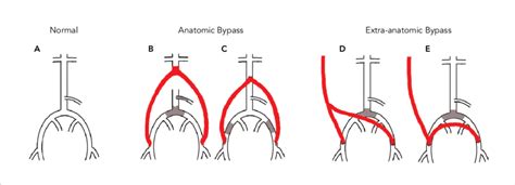 Aorta Femoral Bypass Graft