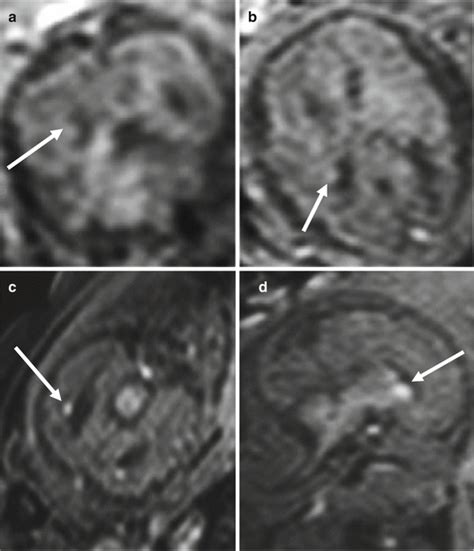 Malformations Of Cortical Development Radiology Key