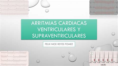 Arritmias Cardiacas Ventriculares Y Supraventriculares Felix Reyes