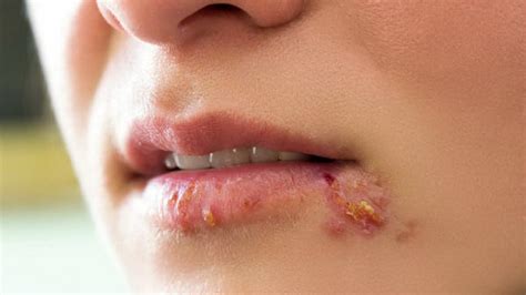 12 amazing home remedies for fever blisters in mouth – Artofit