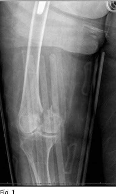 Figure 1 From Distal Femoral Arthroplasty Versus Open Reduction