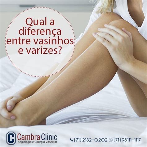 Qual a diferença entre vasinhos e varizes Cambra Clinic