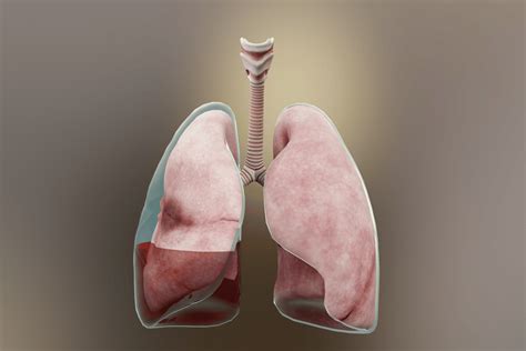 Efusi Pleura In Singapore Interventional Pulmonology Lung