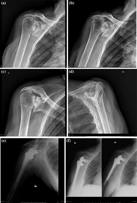 Shoulder Radiology Key