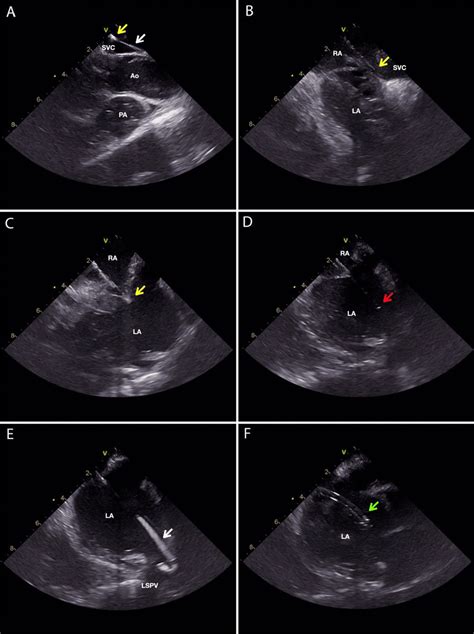 Ice Images Of The Zero Fluoroscopy Transseptal Puncture Guided By Ice