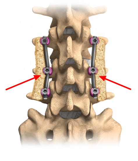 Spinal Fusion Dr Justin Smith