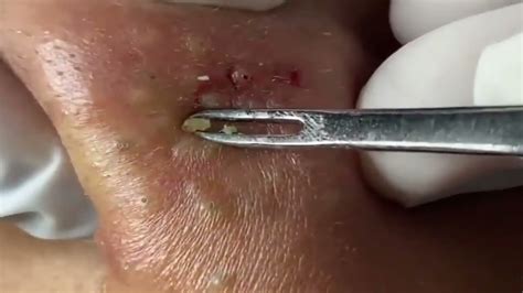 Blackheads Milia Big Cystic Acne Blackheads Extraction Whiteheads