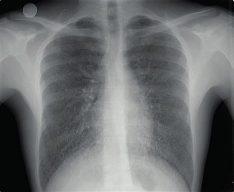 The Patient S Chest X Ray Showing Diffuse Bilateral Reticulonodular