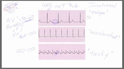 How To Identify Junctional Rhythm