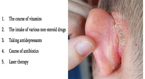 Psoriasis in ears – Causes, Symptoms & Treatment | Psoriasis expert