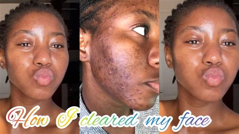 How I Cleared My Acne In 1 Month Hormonal Acne Types Of Acne Youtube