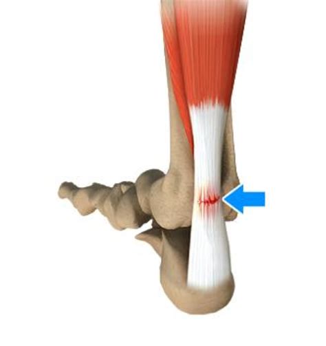 Achilles Tendon Rupture - Bunbury Foot & Ankle Surgeon