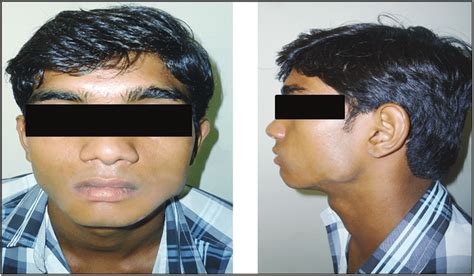 Front And Side Profile Photograph Of The Patient Showing Extraoral