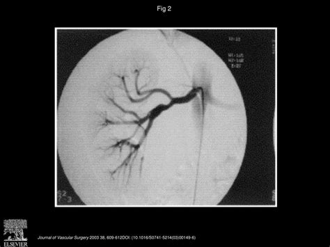 Radial Artery As Conduit For Distal Renal Artery Reconstruction Ppt Download