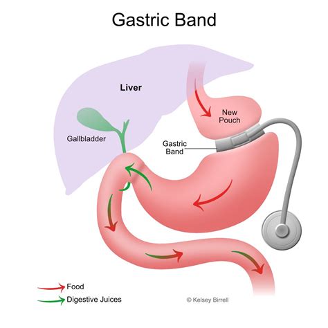 Gastric Band Removal - Toowoomba Bariatric Surgery, South-East QLD