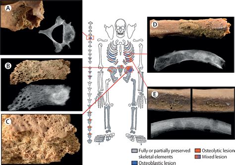 Bone Cancer Skeleton