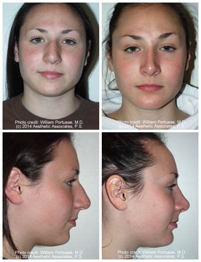 Before And After Rhinoplasty Photos And Images Rhinoplasty Bulbous