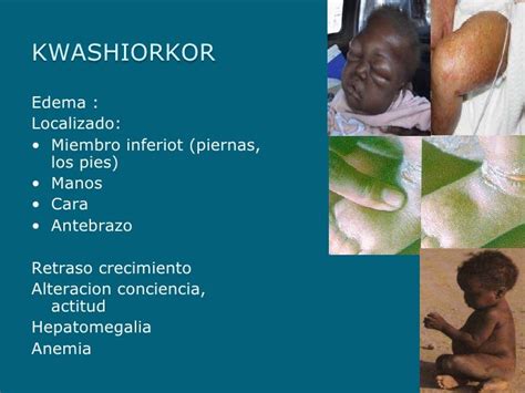 Kwashiorkor