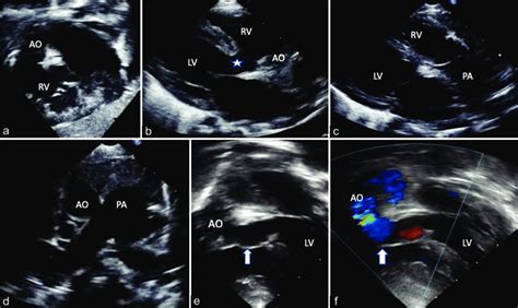 Echocardiogram (a) subcostal short axis view and (b) parasternal long ...