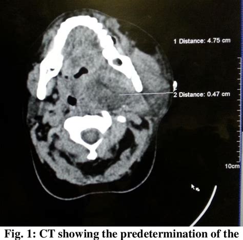 Figure 1 From Percutaneous Ct Guided Needle Aspiration Of A Life Threatening Deep Neck Space