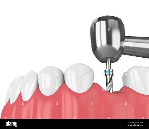 D Render Of Jaw With Dental Implant Drill Implantation Process