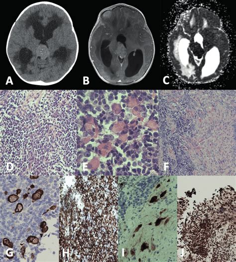 A Contrast Enhanced Axial Computed Tomography CT Scan Identified A