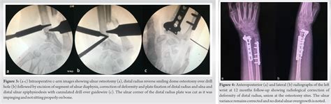 Single Stage Distal Radius Dome Osteotomy With Ulnar Diaphyseal