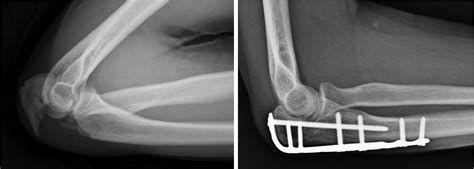 Scaphoid Fracture Open Reduction And Internal Fixatio
