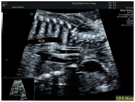 Diagnostic Accuracy Of Ultrasonography For The Prenatal Diagnosis Of