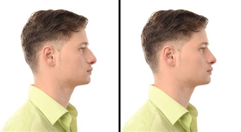 Rhinoplastie Chez L Homme Les Particularit S