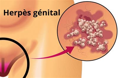 Herpès génital causes transmission symptômes et traitement YouTube