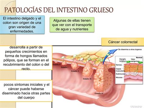 Patologias del intestino grueso | PPT