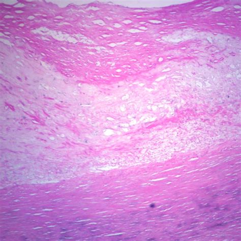 Human Atherosclerosis - Aorta, sec. 7 µm H&E Microscope Slide ...