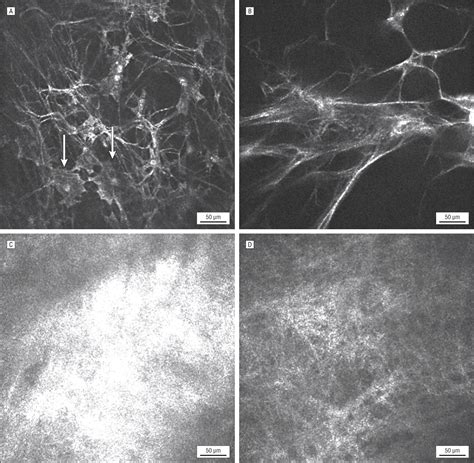 In Vivo Confocal Microscopy Of Filtering Blebs After Trabeculectomy