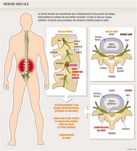 La Hernie Discale Cette Inconnue JOURNAL LA CHOUETTE