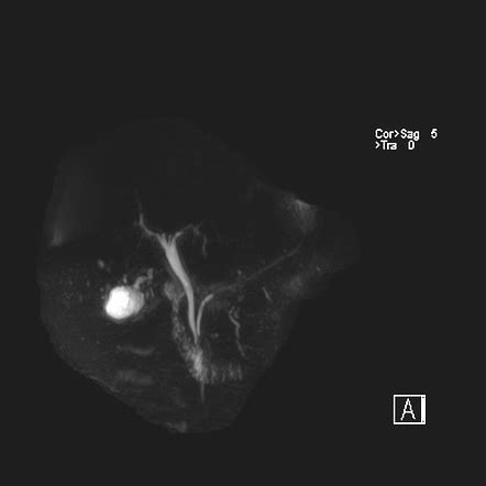 Gallbladder Carcinoma Mural Thickening Image Radiopaedia Org