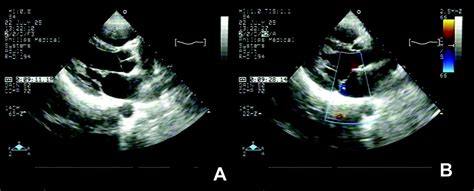 Rheumatic Heart Disease Screening By Echocardiography Circulation