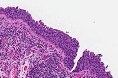 Urothelial Carcinoma In Situ Atlas Of Pathology