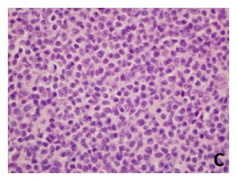 Histological Features Of Lymph Node A And B Right Posterior Cervical Download Scientific