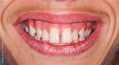 Dental Maxillary And Mandibular Arches In Occlusion With Biting Teeth