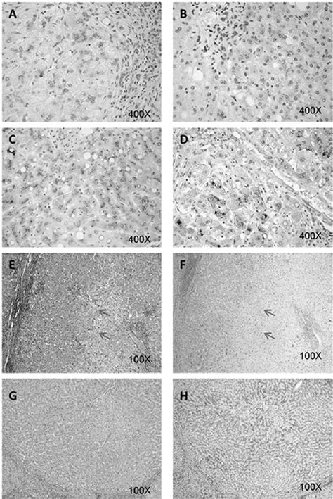 Gpc3 Expression In Cirrhotic Livers Alcoholic Cirrhosis A 400×