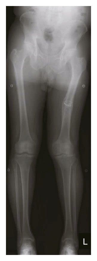 Case 1 Preoperative Anteroposterior Standing Radiograph A Showed An Download Scientific