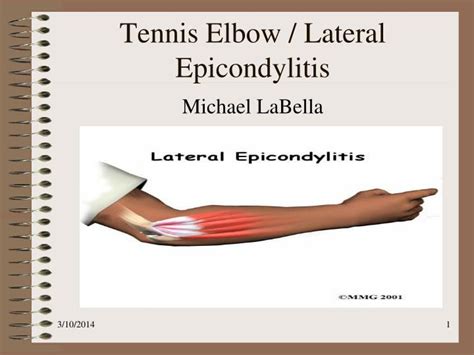 Ppt Tennis Elbow Lateral Epicondylitis Powerpoint Presentation Sexiz Pix