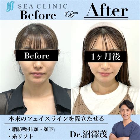 小顔脂肪吸引～症例のご紹介～ Sea Clinic −シークリニック 銀座― 理想を叶える小顔治療