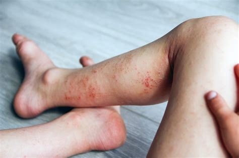 Sconfiggere La Dermatite Atopica Diagnosi E Terapie Efficaci