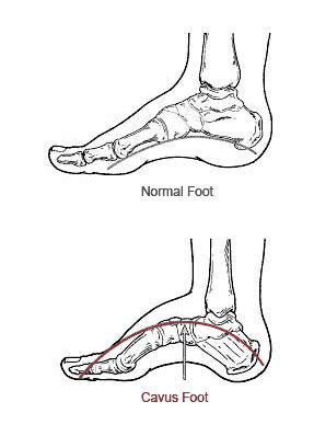 High Arched Foot Western Montana Foot Ankle