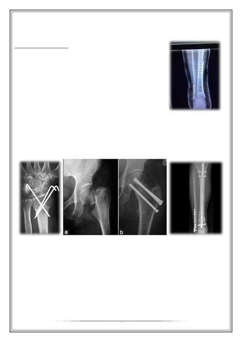 Principles Of Fracture Treatment Pdf D Haider Muhadharaty