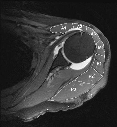 Deltoid Muscle Shape Analysis With Magnetic Resonance Imaging In