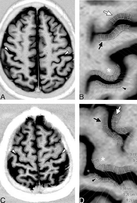 Cortical Thickness Measurements In A Year Old Woman With Primary